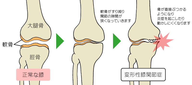 変形 性 膝 関節 症 し て は いけない こと